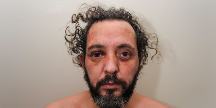 Ebrahim Buzhu, conocido como el 'carnicero de Ámsterdam Primer plano con el rostro visiblemente magullado, con hematomas alrededor de los ojos y expresión seria frente a un fondo neutro.